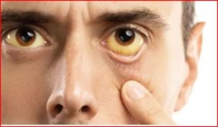 Colombia- Hepatitis C- Hígado- cirrocis- Hombres -Bogotá-