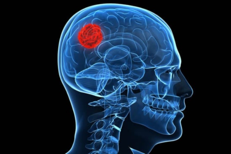Niño de 13 años en Francia logra curarse de un cáncer cerebral mortal